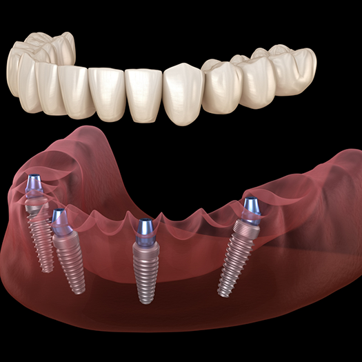 Illustration of a full denture being secured onto four dental implants along an arch