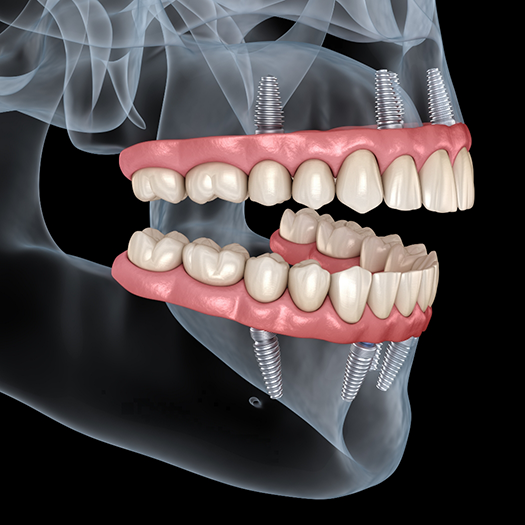 Illustrated x ray of a person with All on X dental implants on both arches