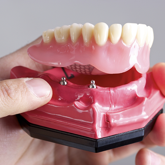 Hand holding a model of an implant denture