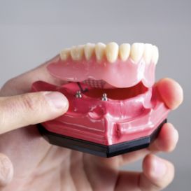 Hand holding a model of an implant denture