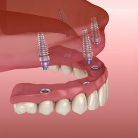 Illustration of a full denture being supported by four dental implants