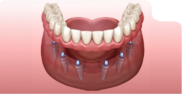 Illustration of a full denture being secured onto six dental implants throughout the arch